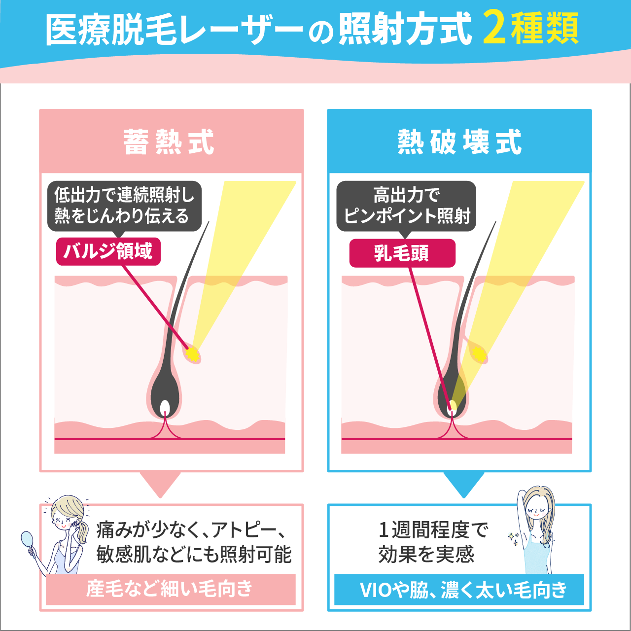 医療脱毛レーザーの照射方式2種類